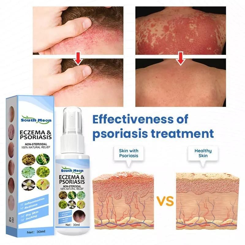 Herbal Psoriasis Relief Spray - Soothing and Moisturizing, Say Goodbye to Scaly Skin for Lasting Comfort, Eczema Relief Spray, Stops Burning and Itching  Pack Of 2