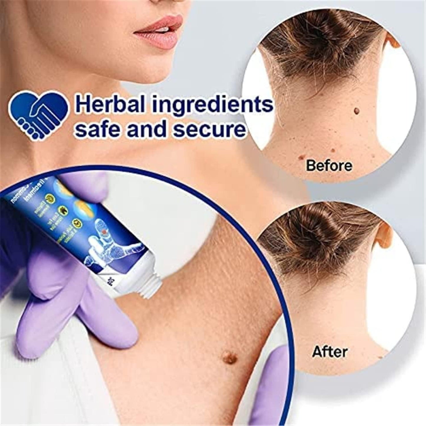 Herbal Warts Remover Cream